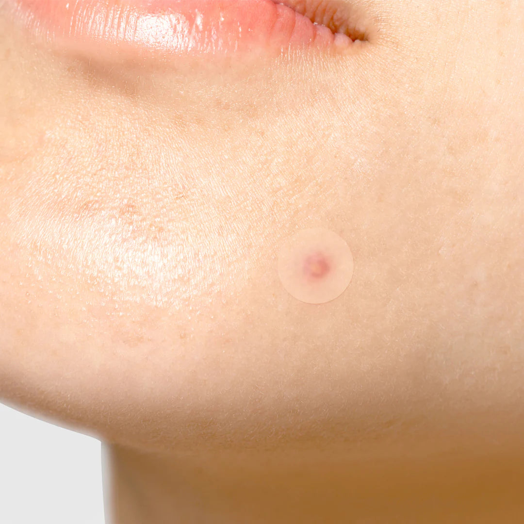 Tiam B Surprise Pimple Patches